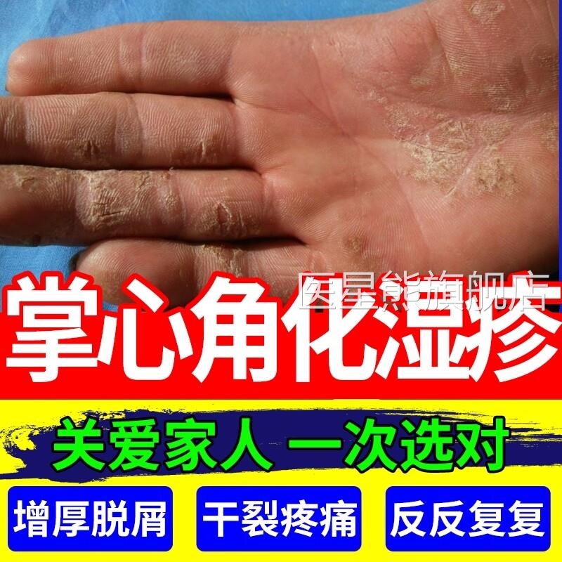 角化型湿疹手癣膏脱皮干特裂真菌感染手部去手足癣膏贴鹅掌风CA医