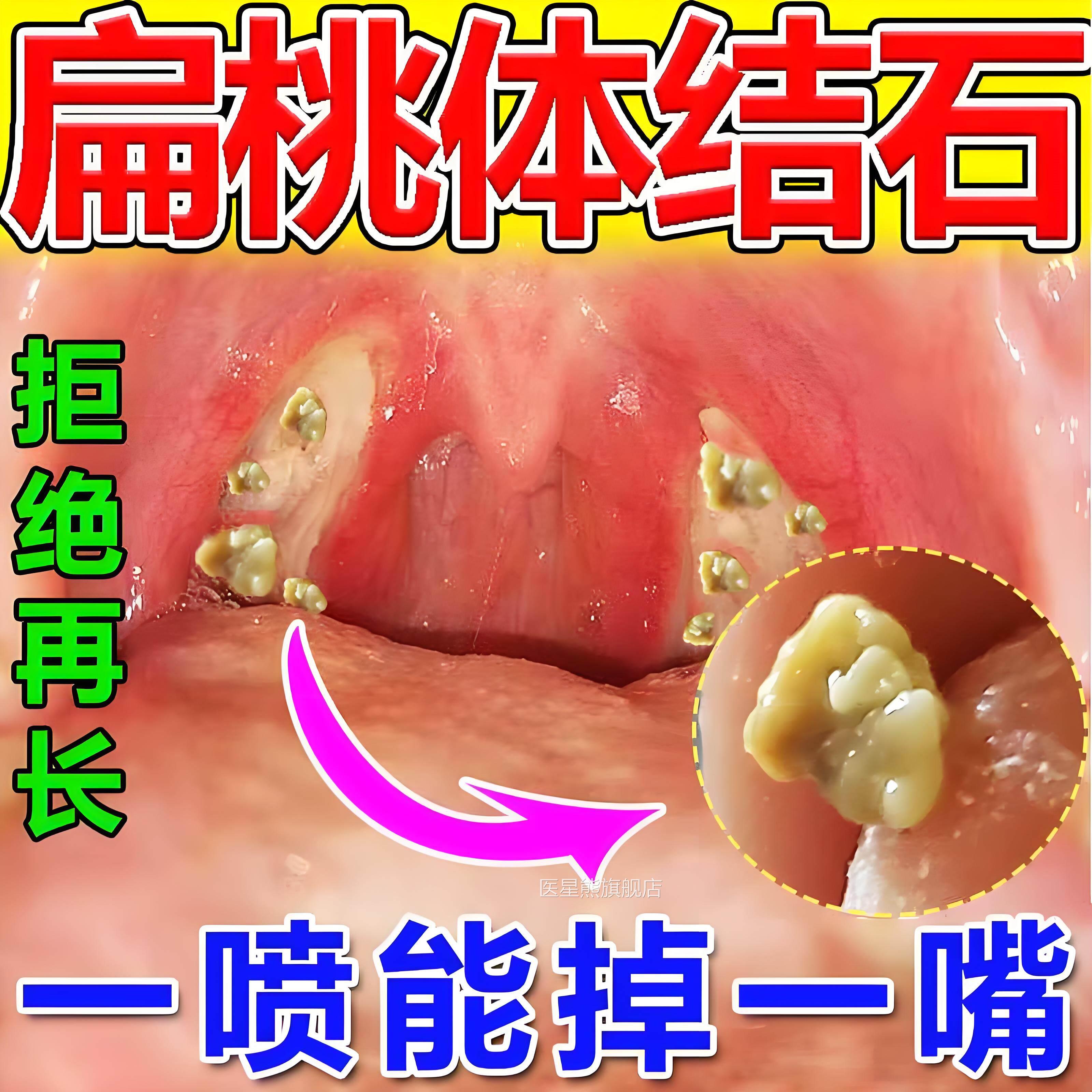 口臭扁桃体结石去除工具漱口水喷剂清神器隐窝理冲洗器口腔清洗器