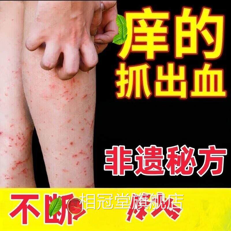 皮肤干瘙燥痒老年人湿疹止去外根用顽固皮炎腿皮肤痒干燥止抑痒菌