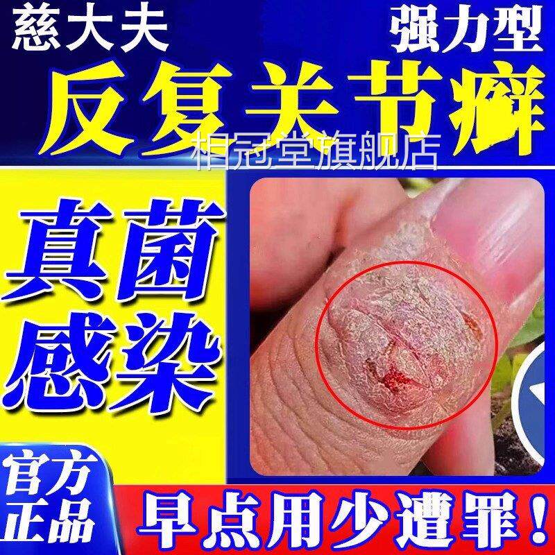 手指关节鲜手裂鲜脱皮干真菌湿手足软皮感染止Y痒药膏LL相冠堂旗