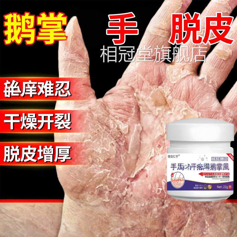 真鹅掌用风手膏脱皮干裂菌感染角化型湿去手部角化皲裂膏相冠堂旗