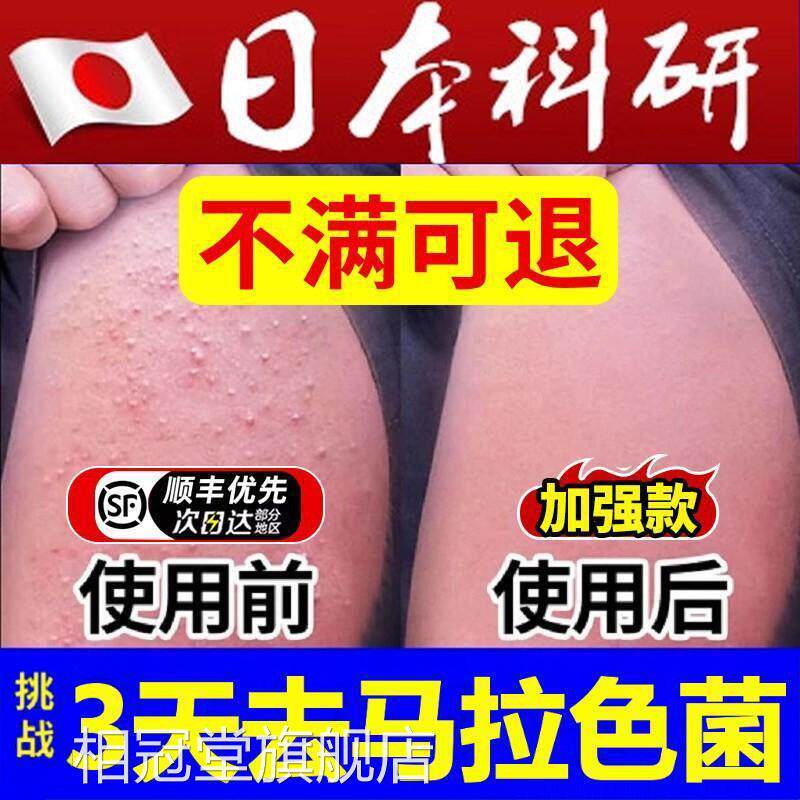 臂毛马手拉色菌专用长痘痘胳膊上脂溢性小疙贴真菌鸡皮肤角化感染