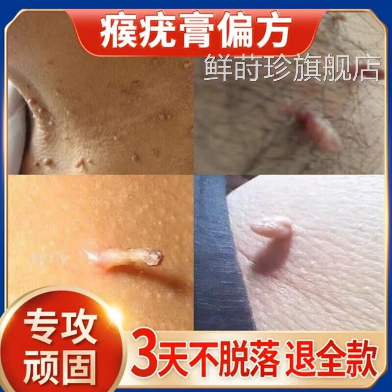 扁平疣瘊子水猴子疙瘩尤瘊肉粒特面部寻常非除效丝状去疣药小膏去