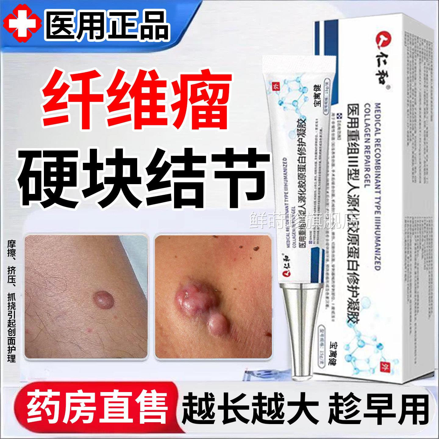 皮肤纤维瘤包去除药膏皮下肿硬块鼓脂肪瘤化瘤结节特消瘤效皮脂腺