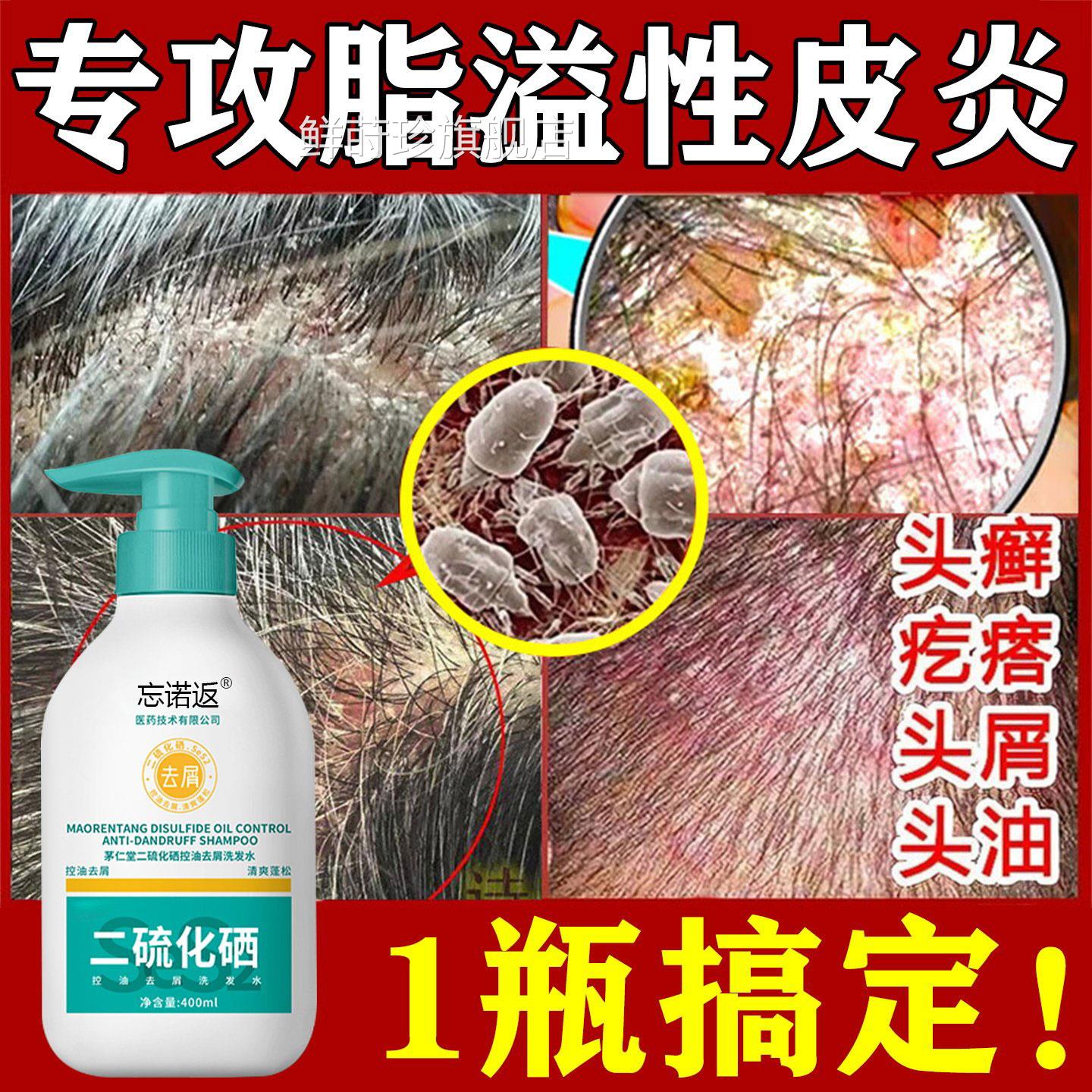 脂溢性皮炎专洗发用水毛菌囊炎去屑止痒抑头皮屑头廯二硫化硒用液
