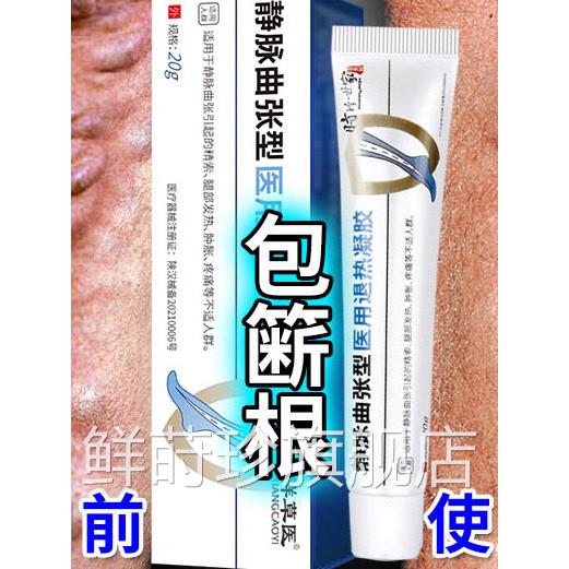 李时珍静脉曲张型退热凝冷敷凝胶蚯蚓腿青筋凸起腿胶部胀痛溃烂药