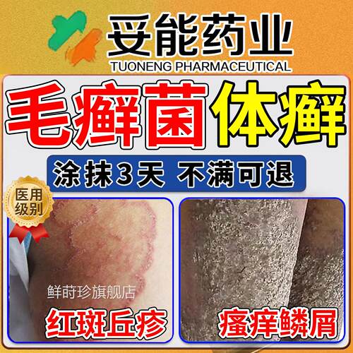 儿童体菌癣去癣药膏股藓大腿内侧治疗红色毛癣真菌感染成人鲜莳珍