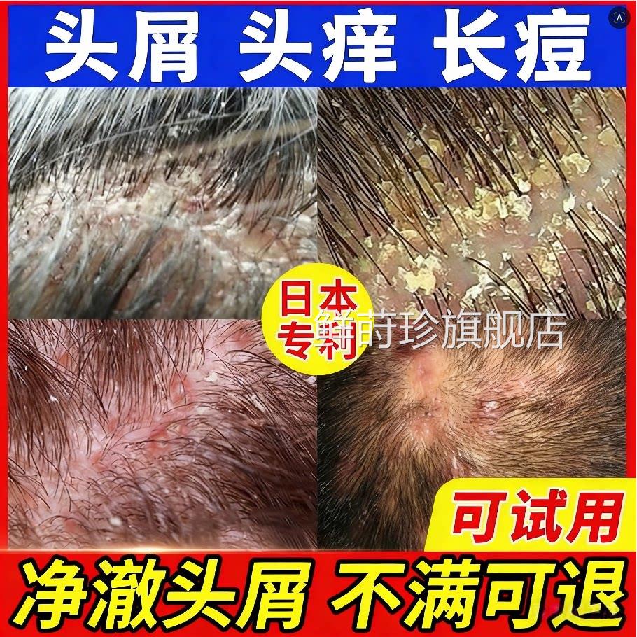 洗发水去屑止痒控油蓬松头螨皮疙瘩毛囊除炎洗发露男官方旗舰店Z