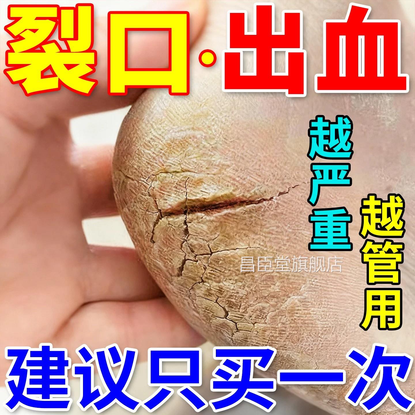 日脚后跟干裂修复霜滋润脚底开裂脱皮起硬皮防本护手足裂口皲裂膏
