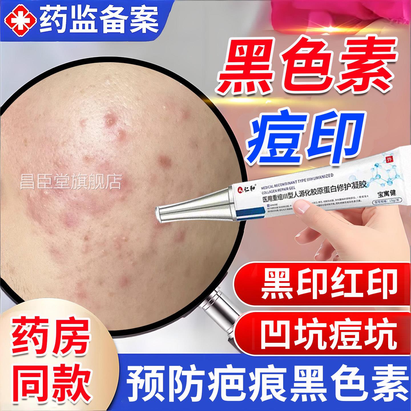 痘印黑色素沉淀去除黑疤印红印痘坑修复男医用型淡化痤疮痕青少年
