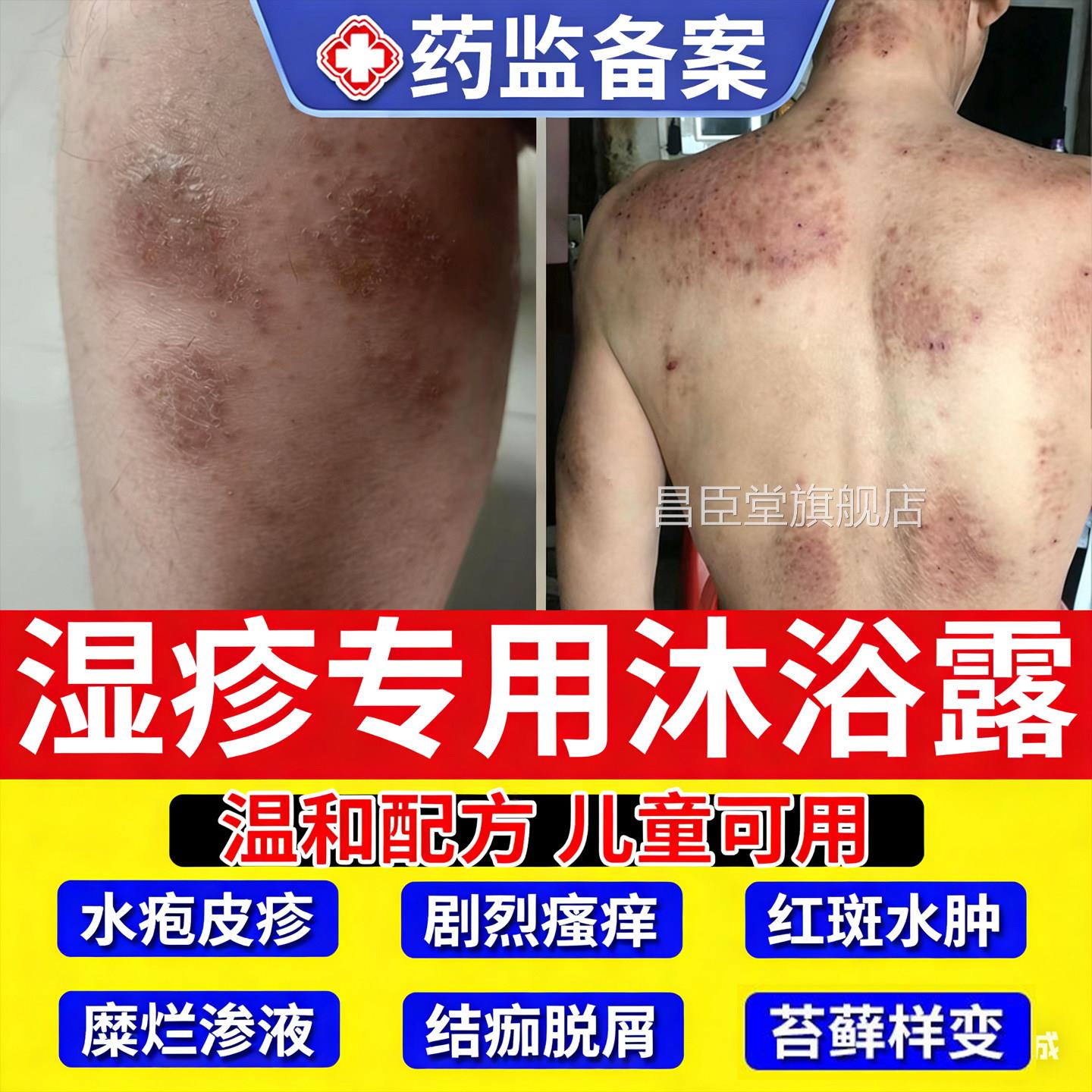 炎皮肤湿疹顽固皮真菌感染皮疹瘙痒去洗剂液根泡澡包专用沐浴露TT