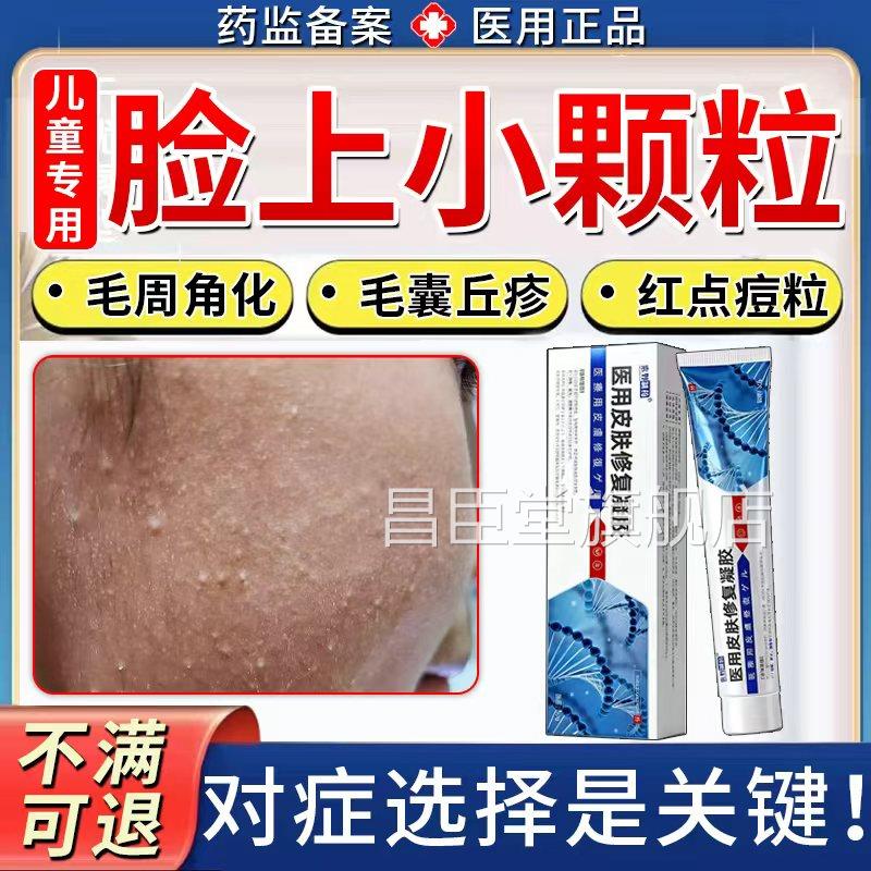 儿童脸上有小颗粒面部毛周角化鸡皮疙瘩肤毛囊角化毛囊炎去除TK昌