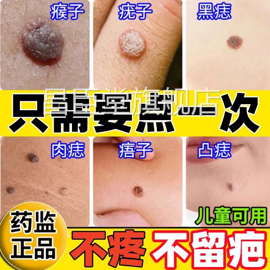 点不留疤痕修复液专用点痣膏 任何肤质适用无痣痕配方正品点痣产