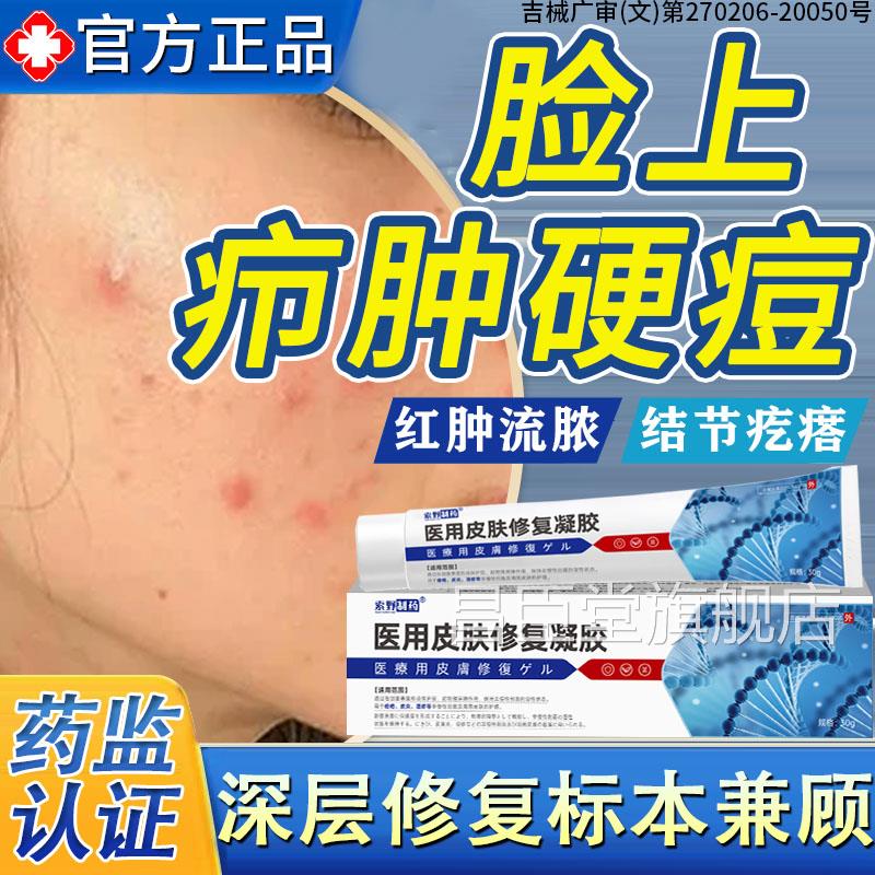 脸上疖肿结节硬块痘痘起硬疙红肿毛囊炎痤疮火疖子囊肿脓包型B瘩D