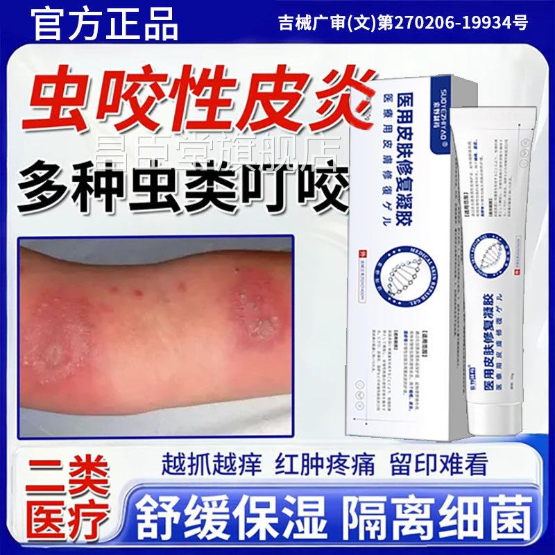 虫咬性皮炎荨麻疹专快速止痒消肿用凝胶植物清凉虫叮咬舒缓蚊膏BD