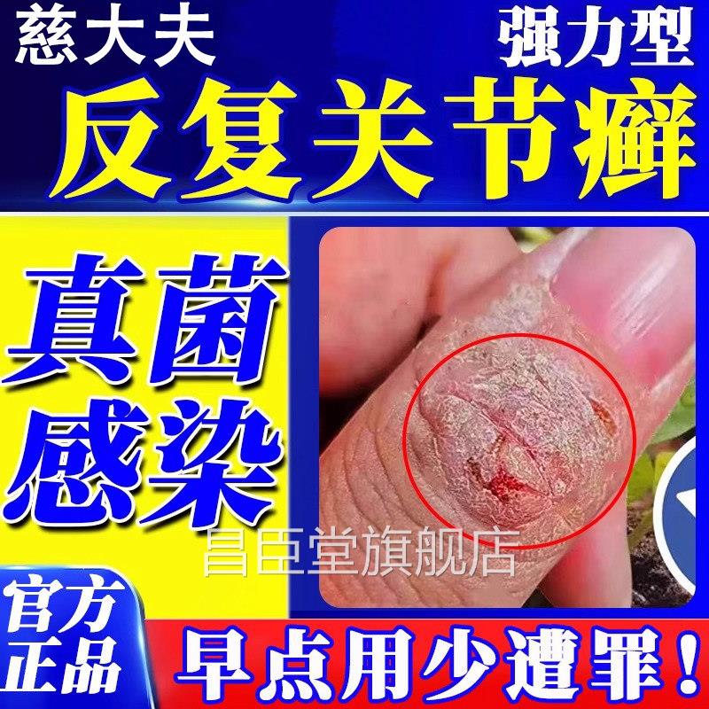 手指关节癣手癣脱皮干 干裂真L菌感染湿疹手足硬皮止痒药监备案药
