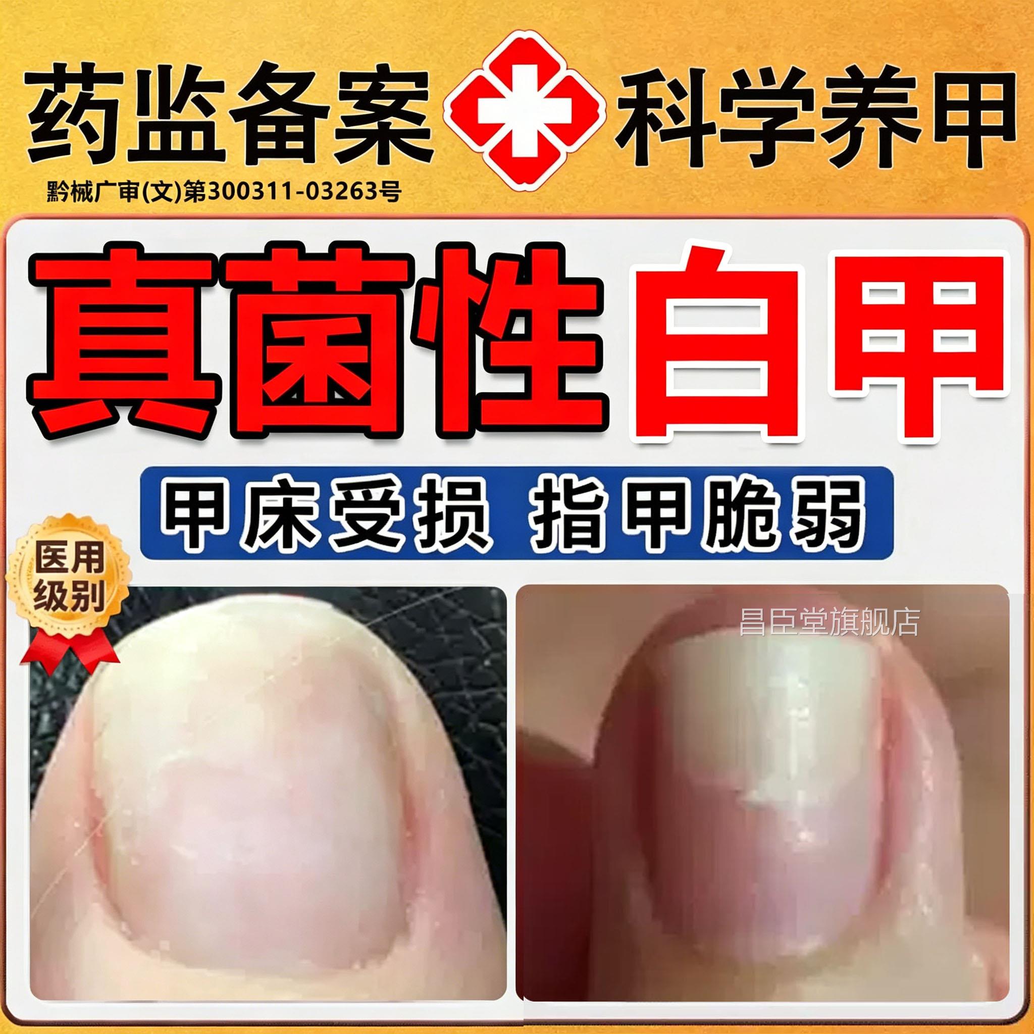 真变菌性白甲银屑病指甲真菌感染脚趾甲增厚黄甲癣专用药房同售LX