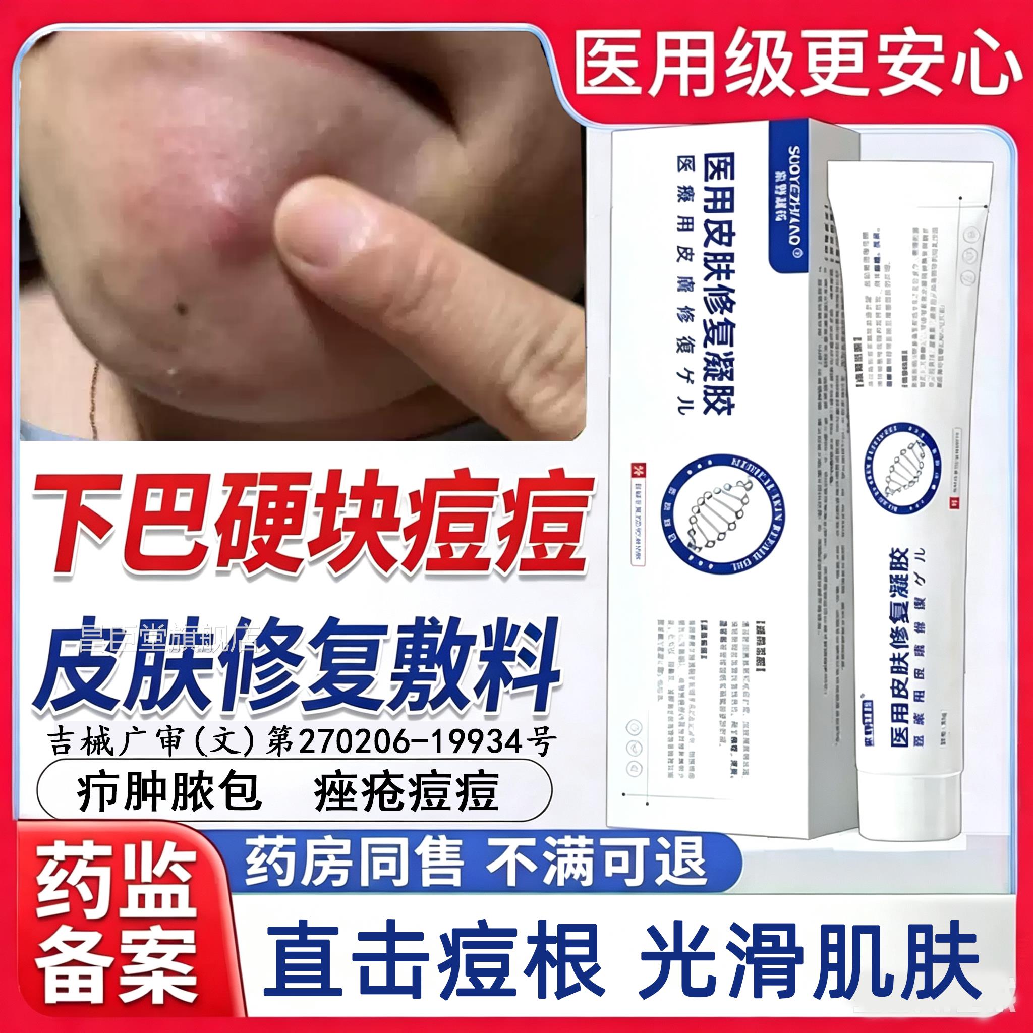下巴反复长硬块痘痘搭膏药贴玫瑰痤疮屏障膏脓包型硬痘疙瘩QQ昌臣