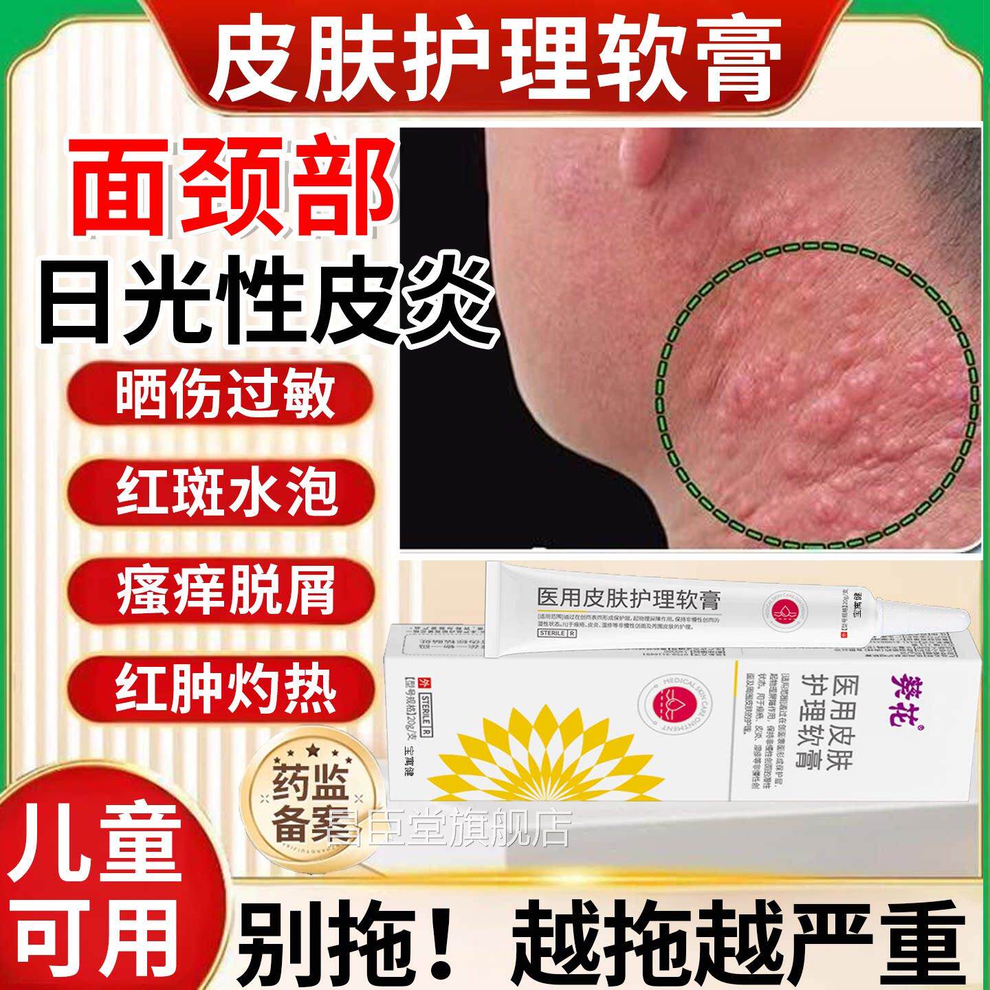 日光性炎皮肤瘙痒敷料外用皮炎皮癣湿痒止痒药皮膏紫外线过敏晒斑