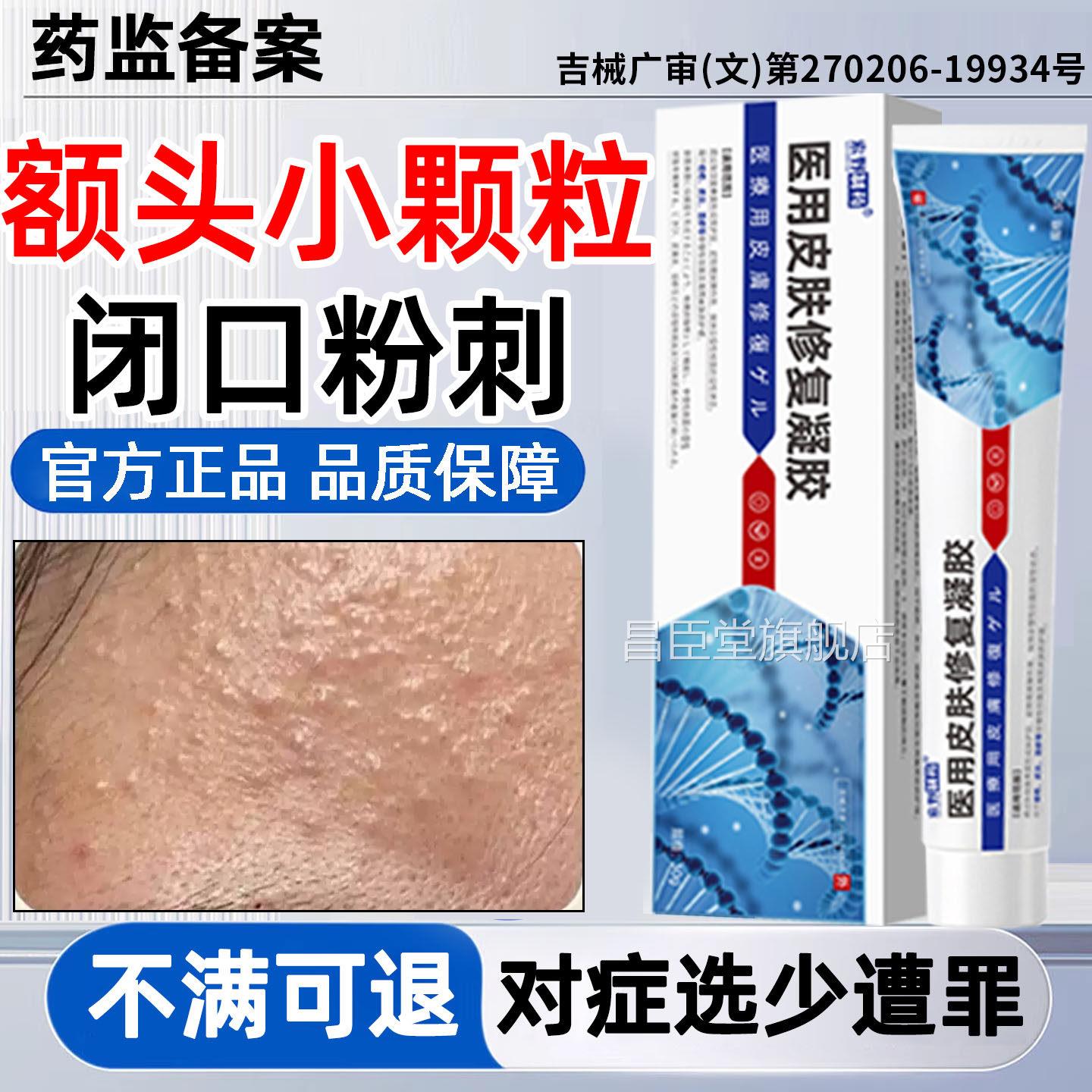 口粉刺小颗粒脸面部逆光疹儿童脸上起小疙瘩屏障受损毛囊堵塞闭QQ