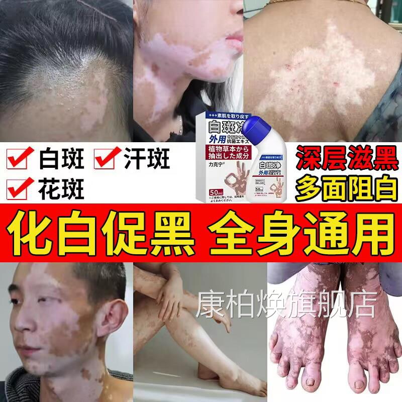 白癜膏风外用白斑净促黑色花素遮盖液补骨脂酚祛白斑净汗斑斑专用