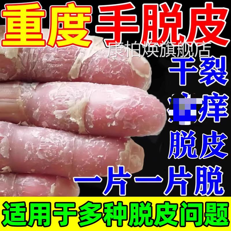 手足脱皮膏手严重脱皮用专真蜕菌皮干燥起皮感染季节性儿童手脱皮