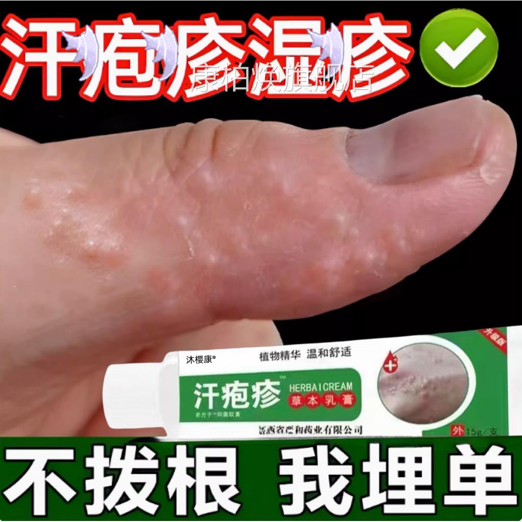 汗疱疹去手上干起小水泡汉汗状真菌感染专用软膏裂脱皮痒根康柏焕