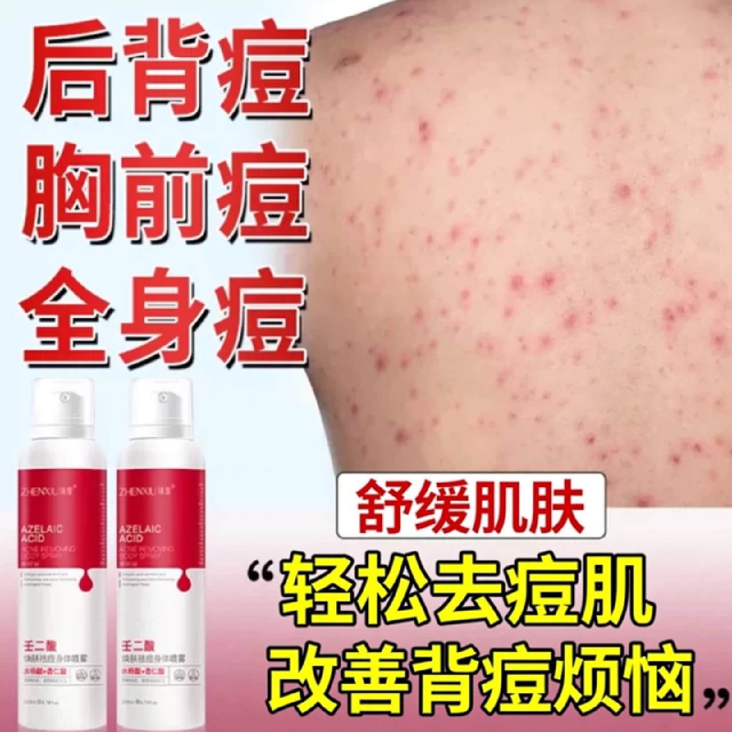 胸前前胸后背长痘痘毛囊炎背上胸口背后马拉色菌药房款膏喷旗舰店