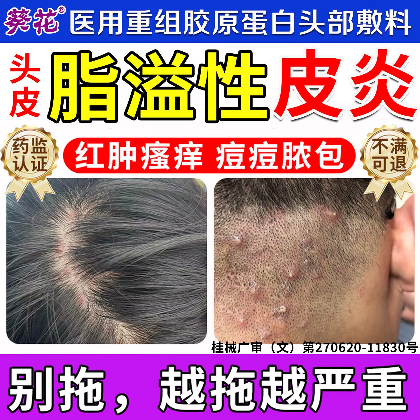 头痒有疙瘩痤疮脂溢性皮炎真菌感染毛囊炎洗发水去屑止痒抑菌旗舰