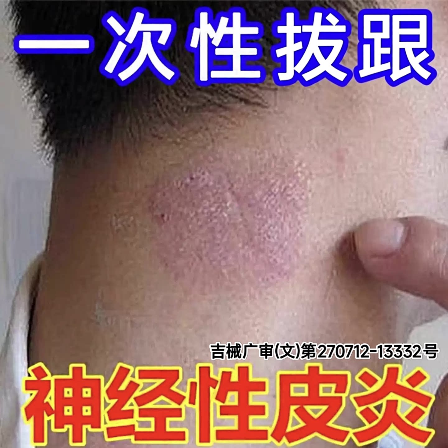 日本神经性皮炎祛除皮肤瘙痒真菌感染顽固止痒杀菌无激素外用旗舰
