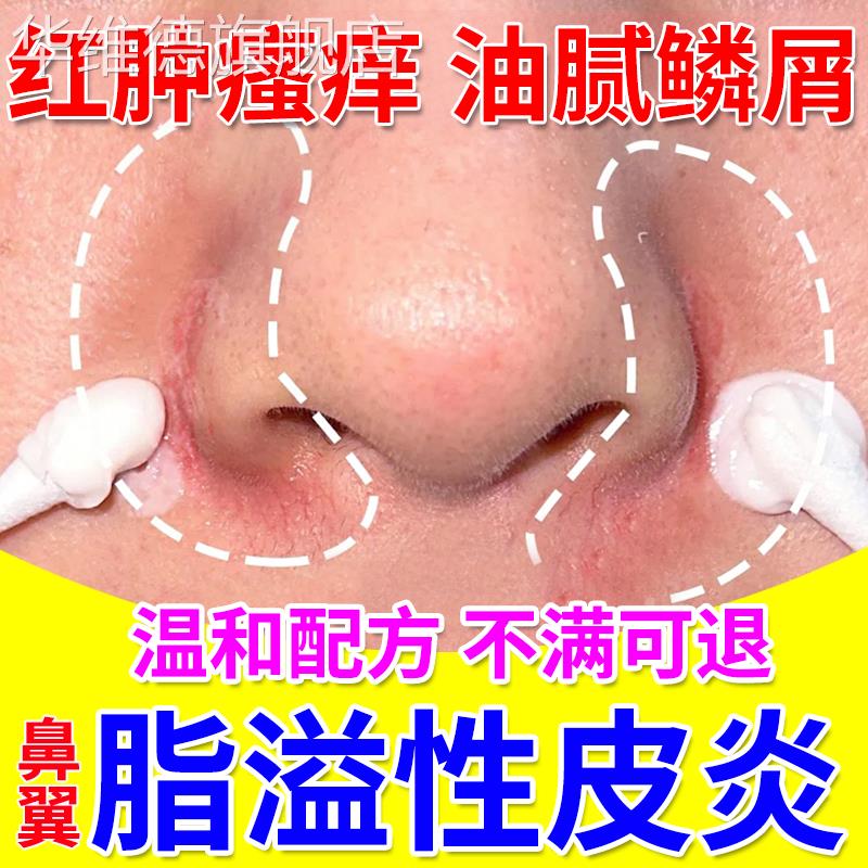 鼻翼脂溢性皮炎面部面霜软膏鼻子两侧发红马拉色菌干燥起皮脱皮UU