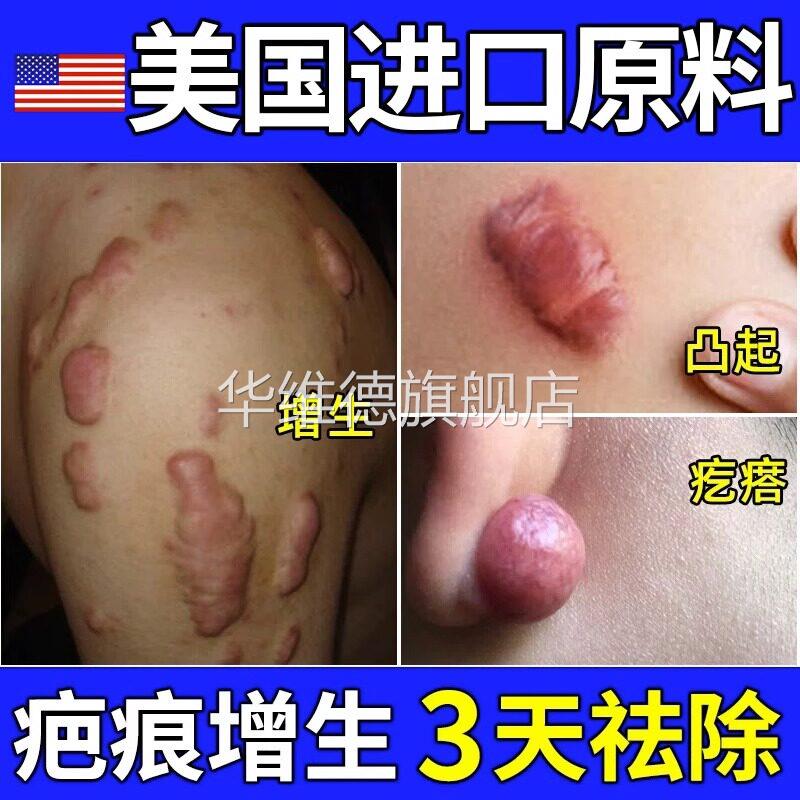 疤痕增生凸起疙瘩去瘢痕剖腹产伤疤可搭除疤去除修复祛疤去疤膏贴