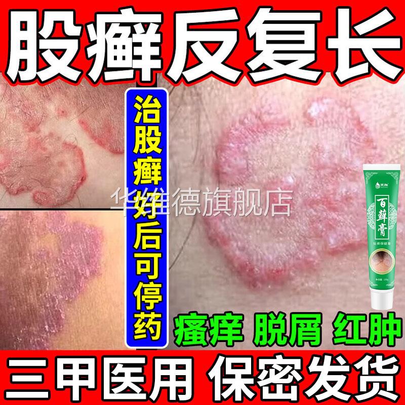 大腿内侧皮肤瘙痒止痒去专外用特根效药股藓毒痒克星湿疹顽固皮炎