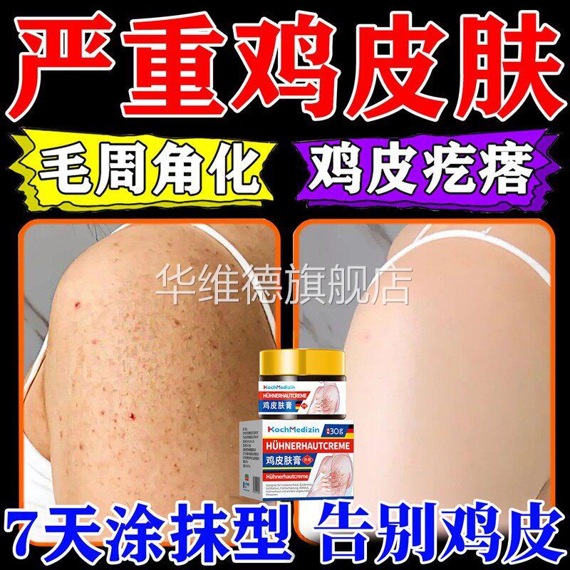 去鸡皮肤疙瘩药毛囊角化角质症专去除膏全身手臂腿鱼鳞用神器儿童