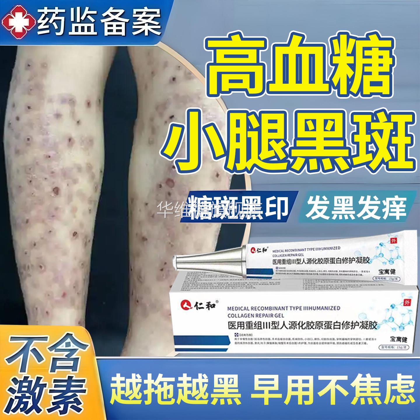 糖尿病疤痕印引起小腿黑斑去胫前除腿上糖斑皮肤痒色素沉着烂足膏