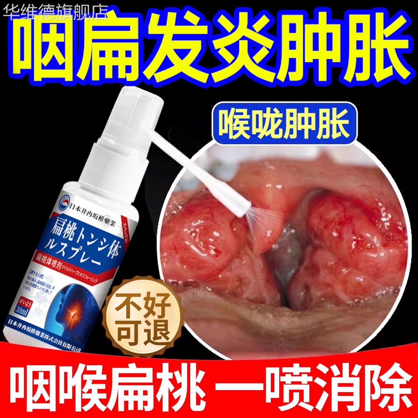 咽喉炎慢性咽炎贴除根喉咙专用有痰异物感干痒咳嗽喷雾剂治疗咽炎