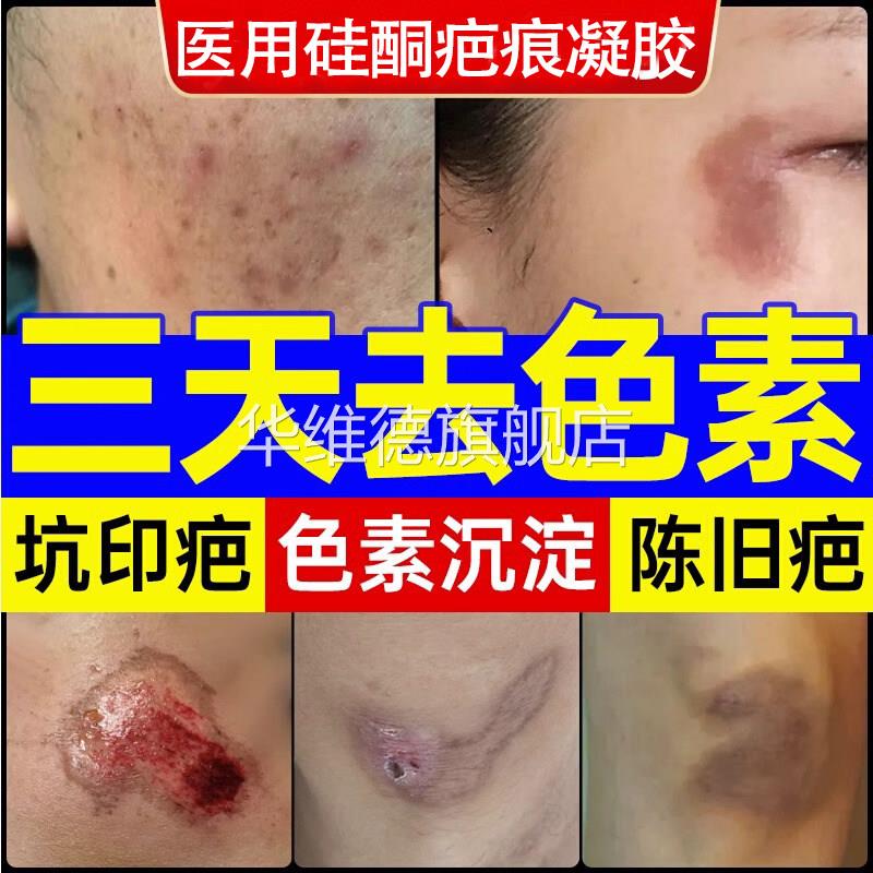 祛疤膏去黑色素沉着修覆沉淀去除去疤印祛痘印脸部疤痕修覆除疤膏