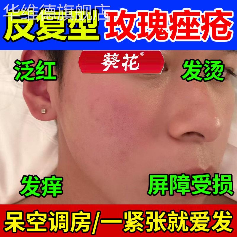 葵花玫瑰痤疮屏障修复软膏凝胶酒槽鼻搭护肤品面霜药监备案医用级