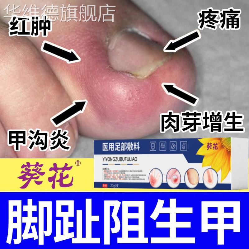 脚趾甲阻生甲脚趾头红肿疼痛增厚分层断裂开嵌甲沟炎肉芽增生变形