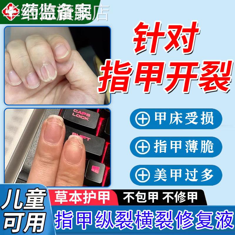 手脚指甲开 裂修覆液中间断裂纵裂药凹凸不平薄软受损再生养甲床T