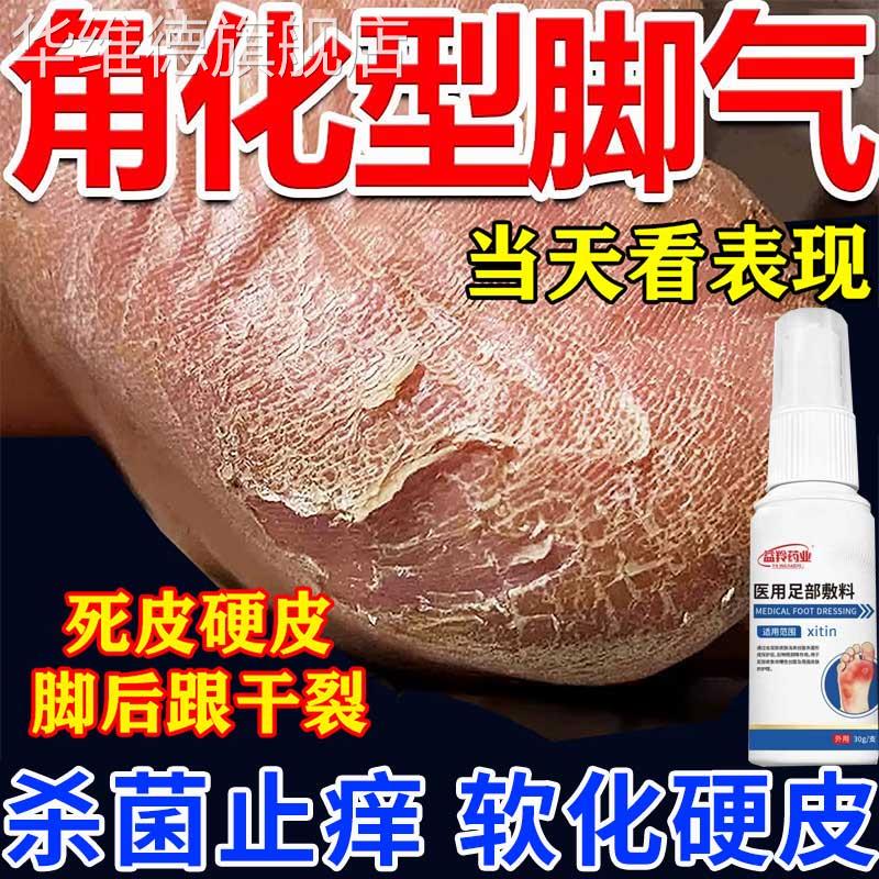 脚后跟干裂起硬皮真菌感染角化型脚气足跟开裂足癣脚癣一次净ZT华