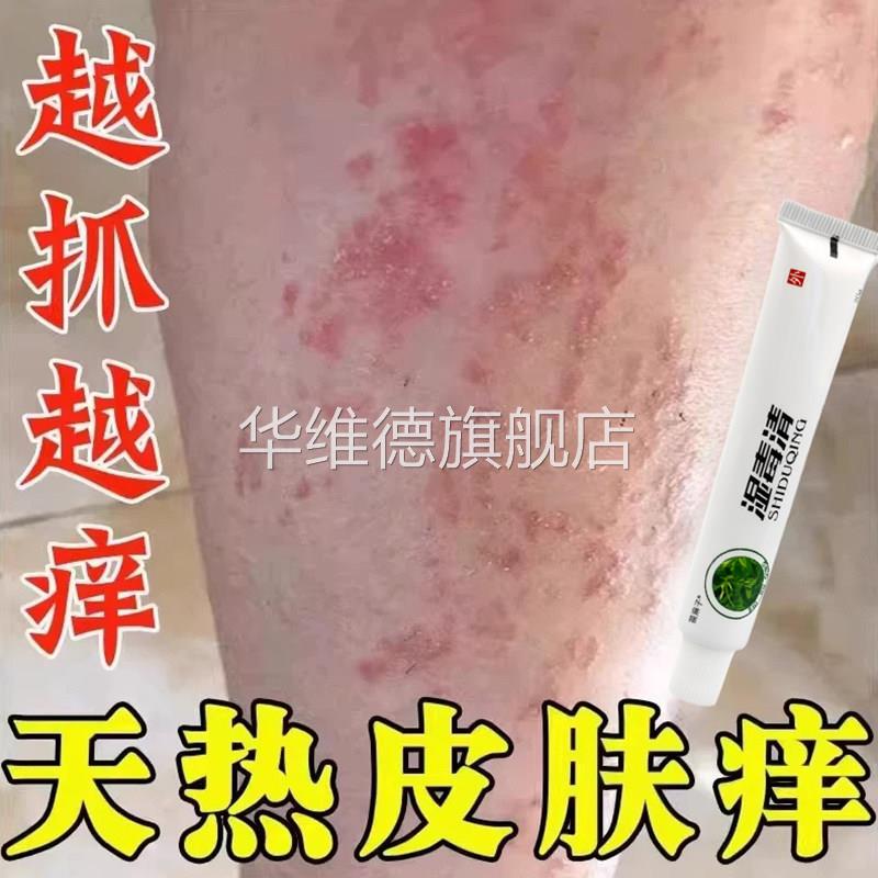 夏天小腿痒湿成人止痒膏出汗身上痒天热皮肤瘙痒热疙瘩红疹热毒华