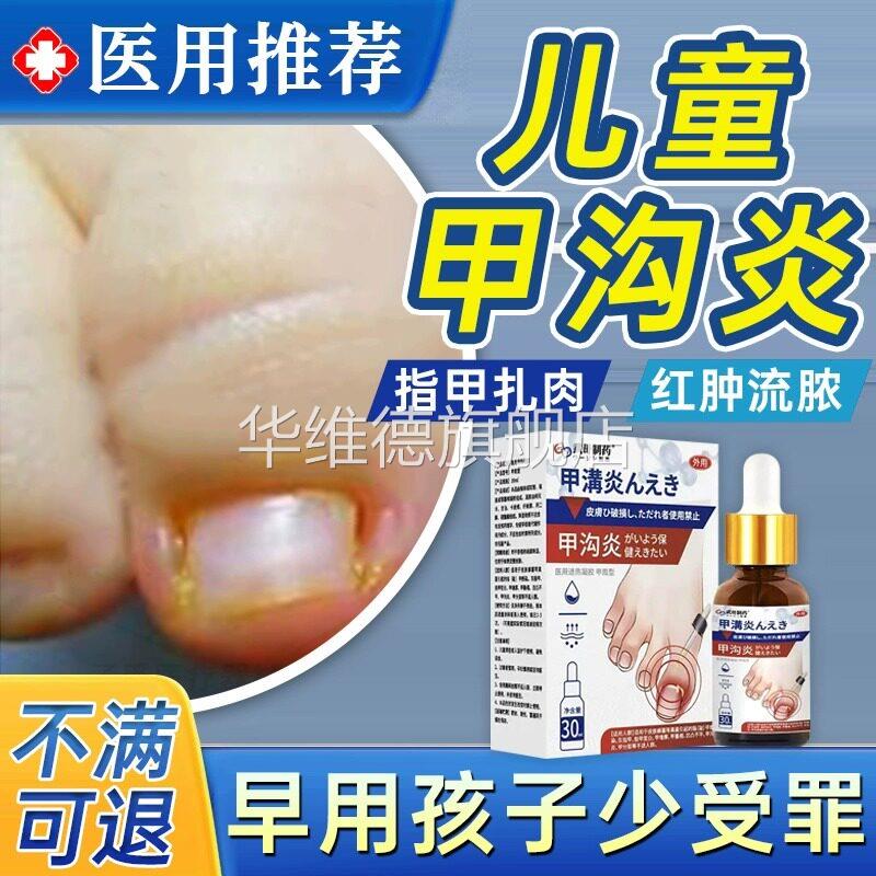 儿童甲沟炎治疗特效灰指甲膏息肉去除矫正器消炎脚大拇指软化嵌LL