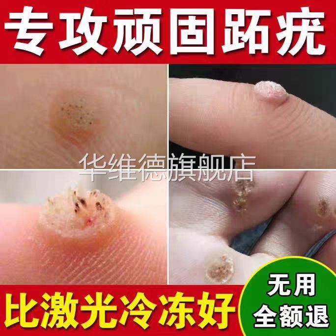 草本鸡眼贴鸡眼膏药水瘊子手足部去脚底脚趾部跖疣老茧根肉刺qx华