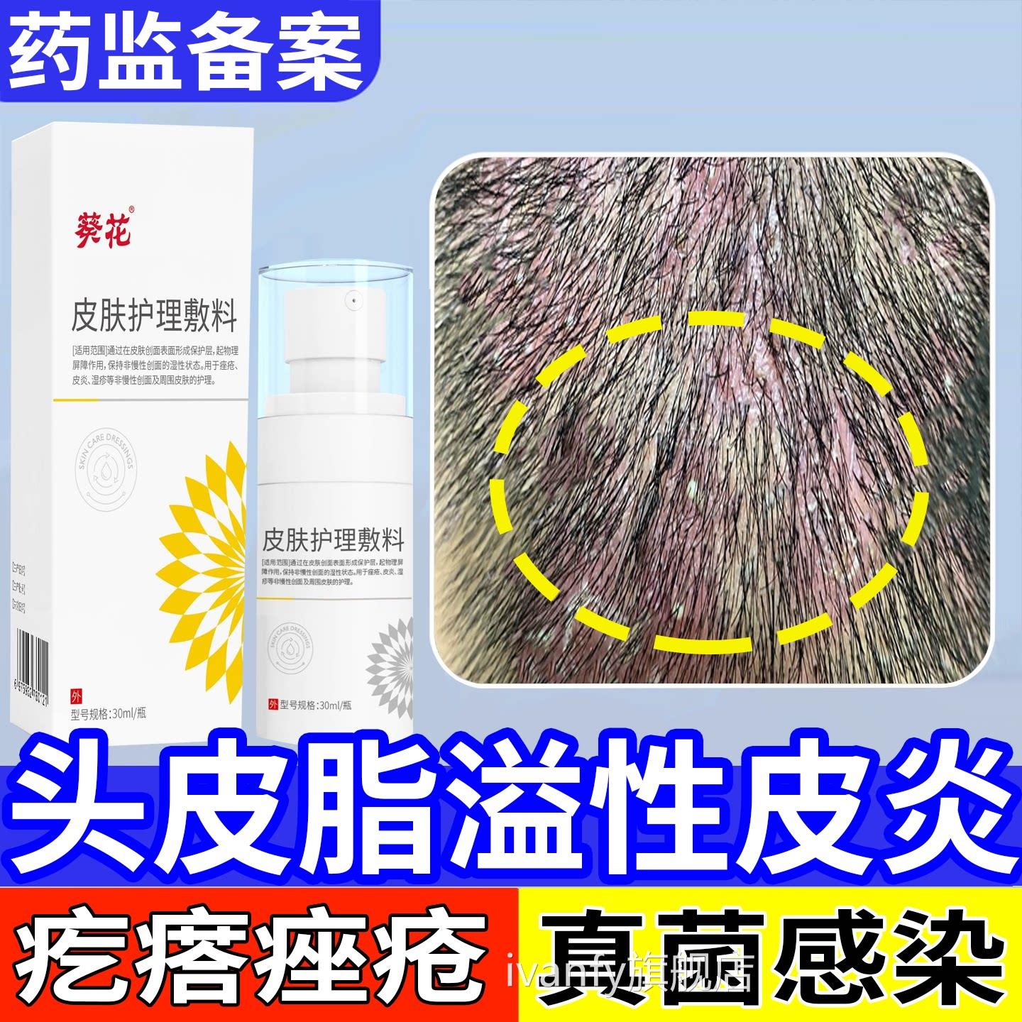 头皮脂溢性皮炎真菌屑感染头癣部喷剂精华头痒有疙瘩痤疮马拉色菌