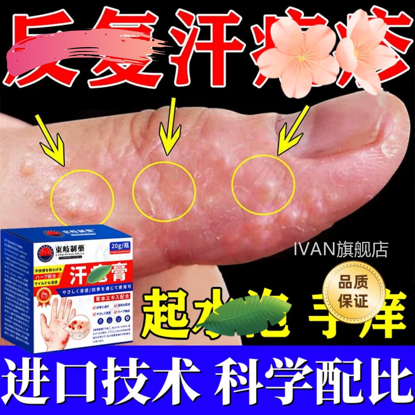 手上起小水泡汗状疱痒疹带状真杀用菌感染止湿手气脱皮痒专去疹膏