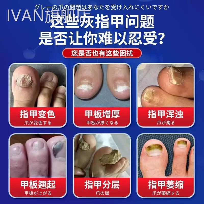 灰指甲日本进口技术水灰趾甲修复脱甲增Q厚空甲一滴正品抑菌净液T