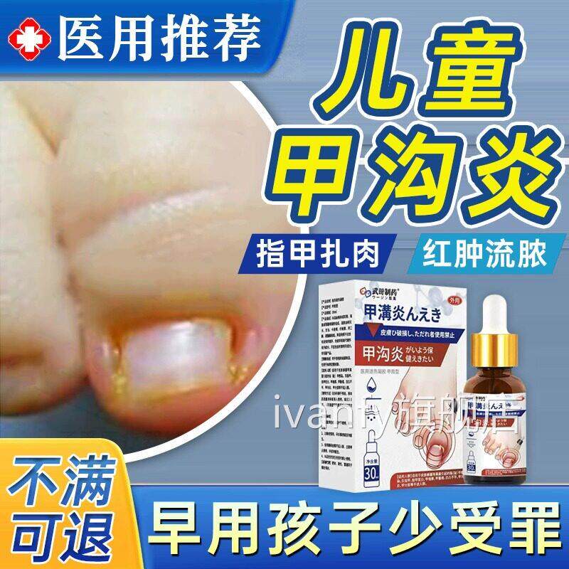 儿童甲沟炎治疗特效灰指甲膏息软肉去除矫正器消炎脚大拇指化嵌LL