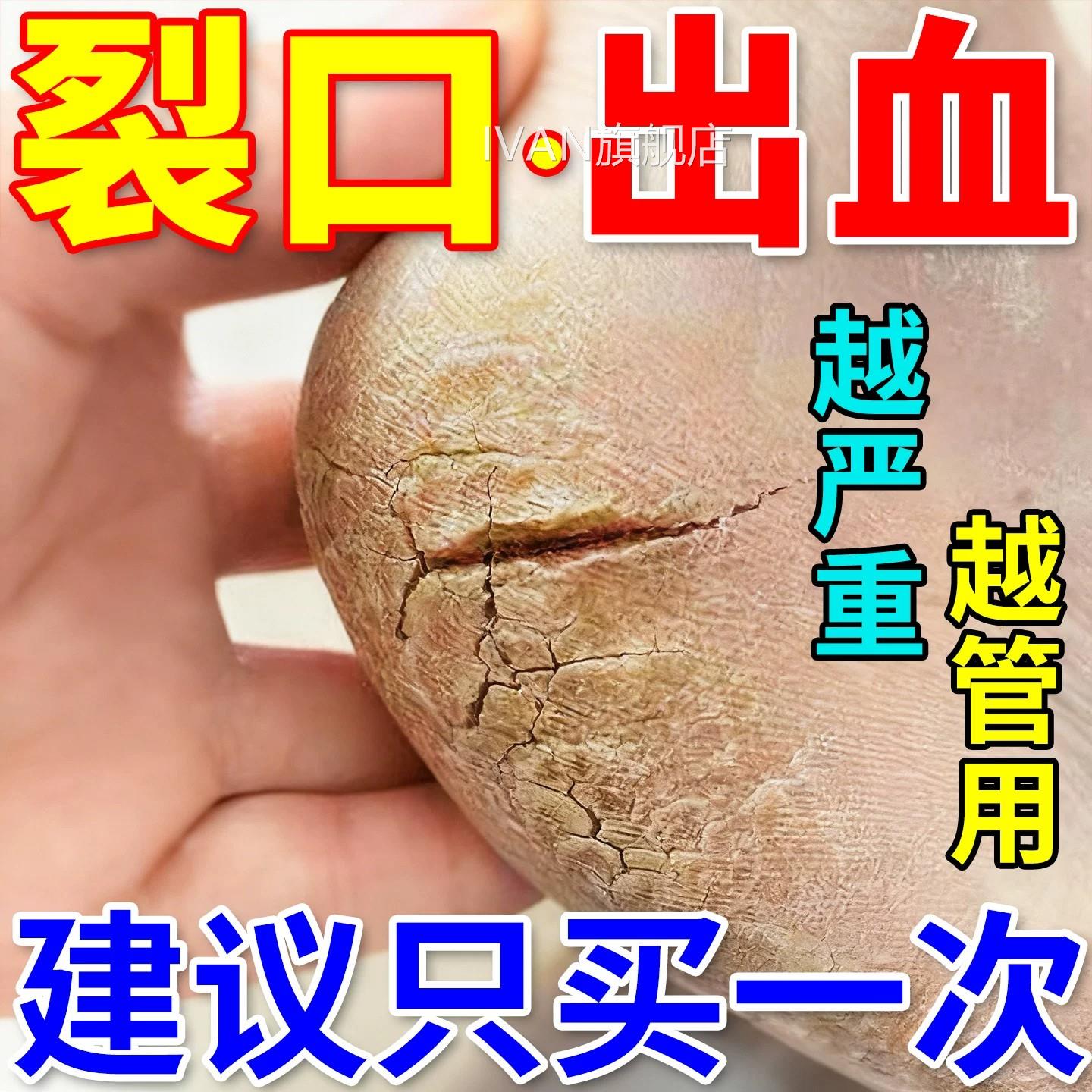 日本脚后跟干裂皲修复霜滋润脚底开裂脱皮起硬皮防护手足裂口裂膏