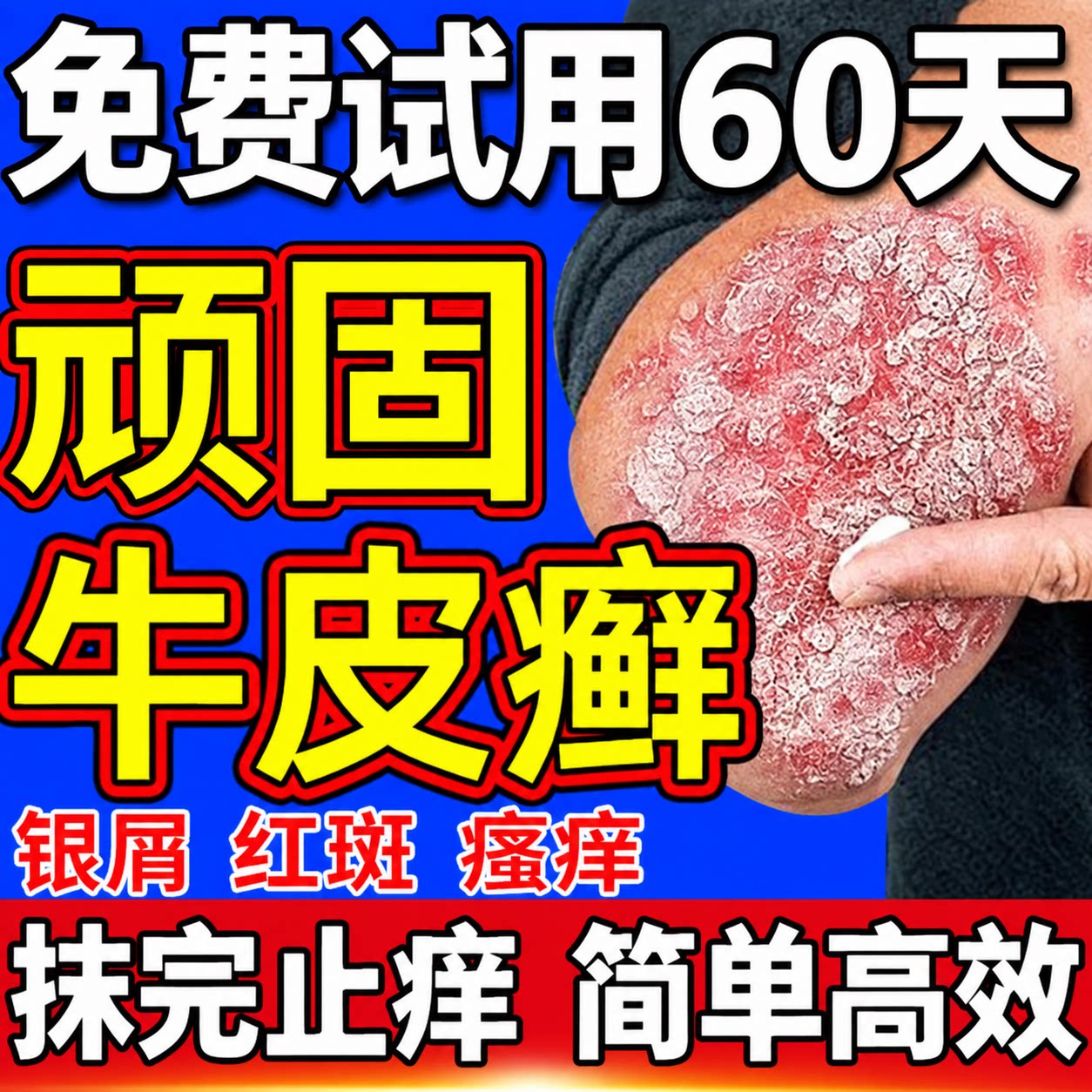 顽固牛皮癣银屑病专用皮肤瘙痒炎